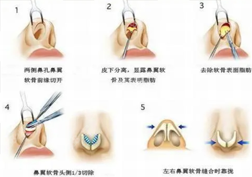 北京刘彦军做初鼻手术图