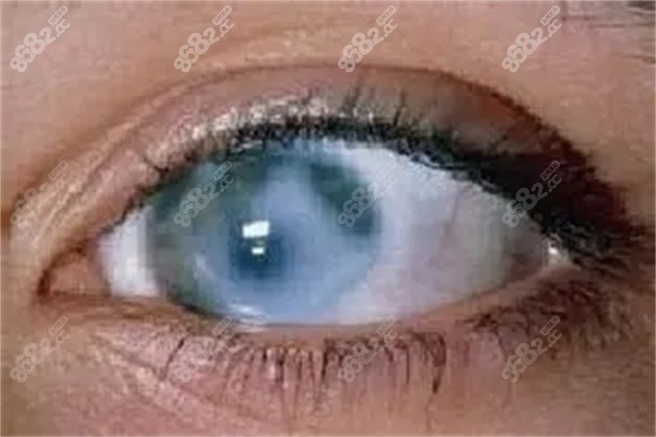 青光眼有哪些手术类型