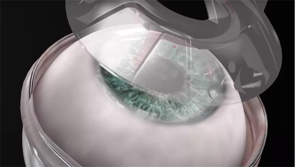 角膜薄是否就要做角膜交联手术，角膜交联手术有什么优点