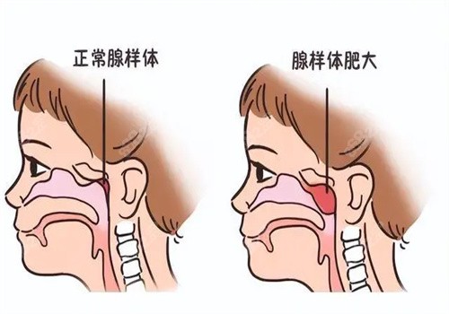 腺样体面容矫正器有用吗