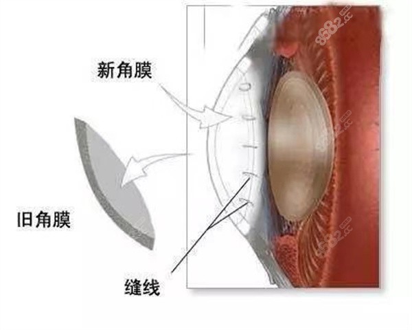 角膜屈光手术与结膜手术的区别