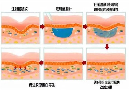 聚左旋乳酸对皮肤的作用