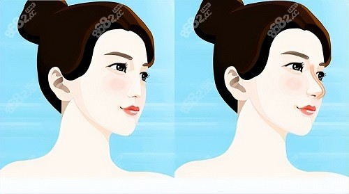 济南诺德罗晋隆鼻的口碑