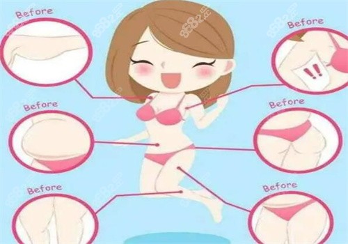 深圳米兰柏羽钟伟洪医生吸脂怎么样