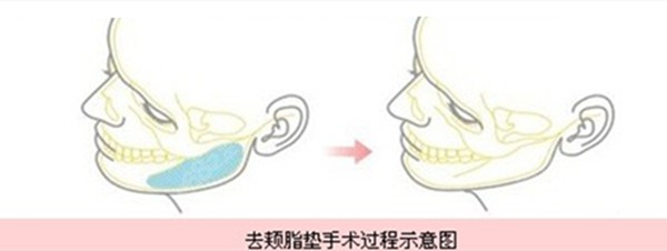 颊脂垫去除会引起面部下垂吗