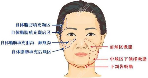 颊脂垫去除会引起面部下垂吗