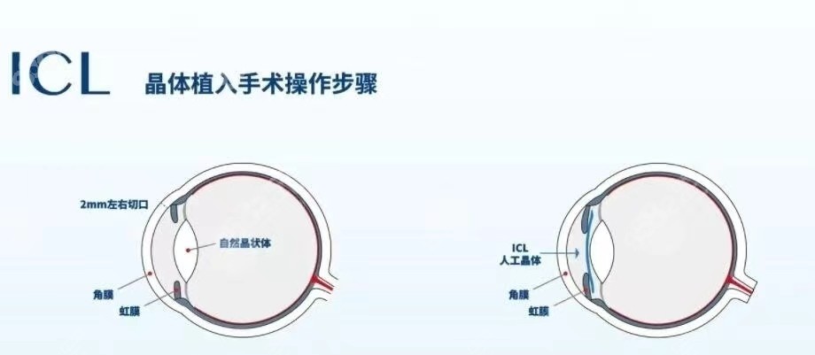 ICL术后多久可以化妆