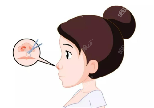 北京联合丽格整形医院隆鼻手术图