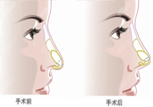 北京联合丽格整形医院隆鼻手术图