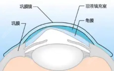 巩膜镜