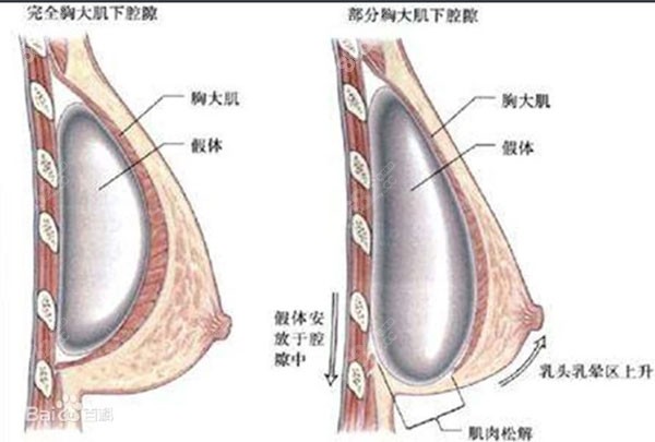 丰胸