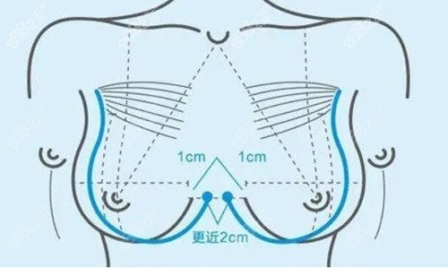 上海美莱假体隆胸技术