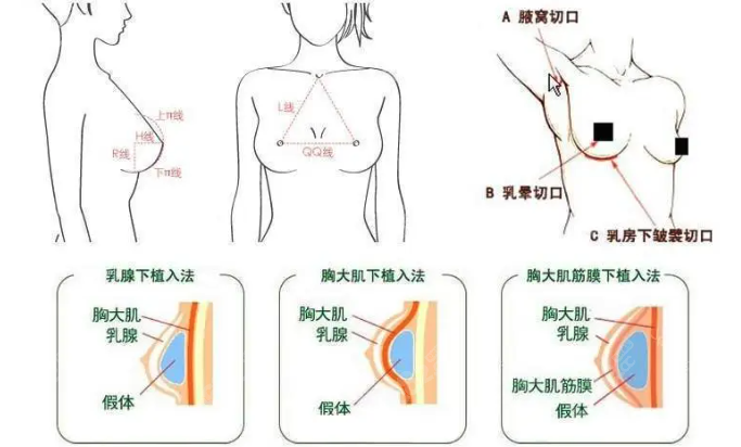 冯辉利隆胸怎么样