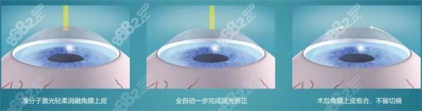 近视眼手术复发还能再次手术吗