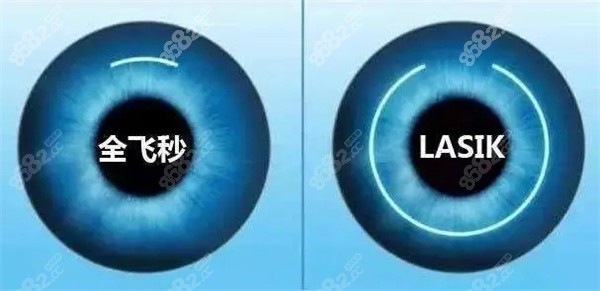 近视眼手术复发还能再次手术吗