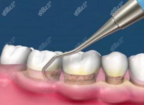 牙菌斑怎么治疗才能除根
