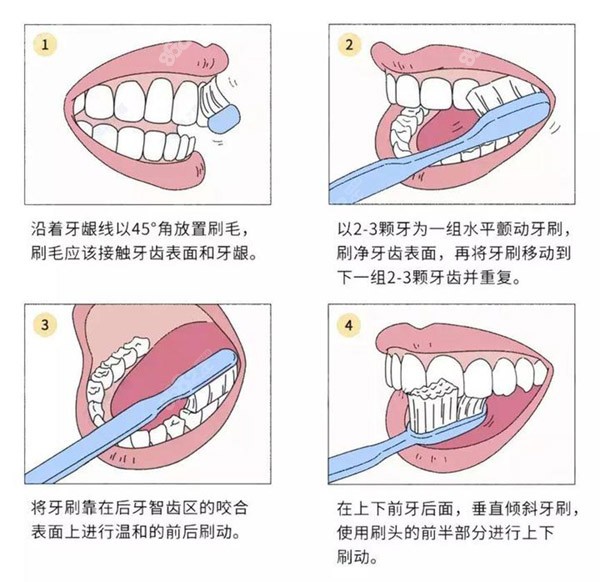 牙菌斑怎么治疗才能除根