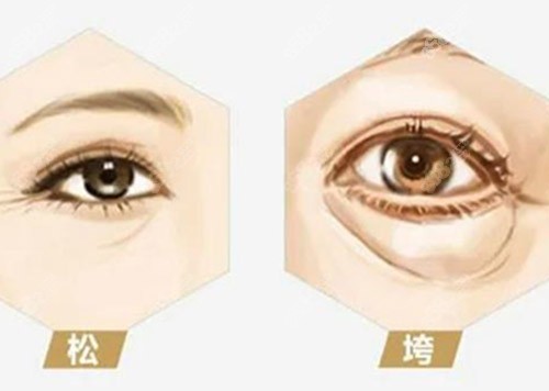 激光去眼袋和溶脂去眼袋