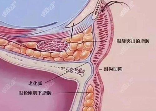 激光溶脂去眼袋原理