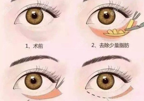 激光去眼袋和溶脂去眼袋的区别