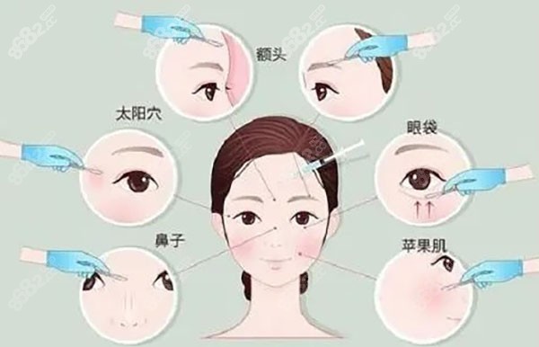 生长因子填充