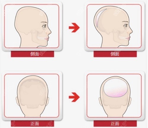 后脑勺PEEK、骨水泥、珊瑚骨等材料的区别