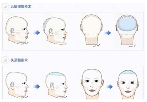 peek后脑勺填充医院排名
