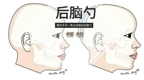 后脑勺填充手术多少钱