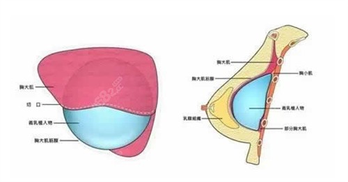 杭州艺星医疗美容的无痕动感隆胸技术备受称赞