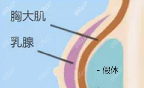 杭州艺星医疗美容的无痕动感隆胸技术好