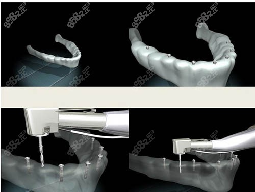 种植牙步骤图