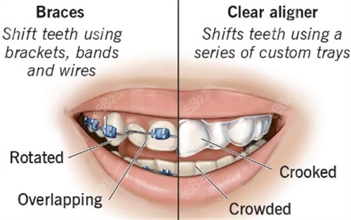 自锁金属牙齿矫正和隐形牙齿矫正的区别图解.jpg