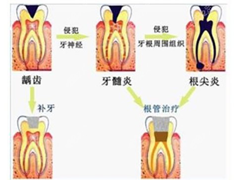 牙髓炎怎么治疗