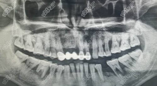 缺牙口腔ct照片