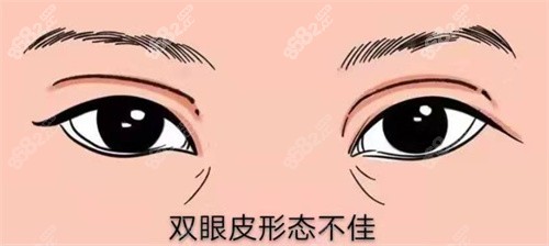 双眼皮过宽