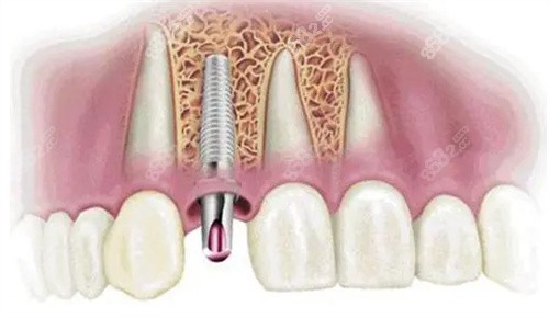 种植牙模型图