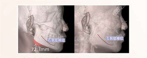 杭州下颌角截骨多少钱