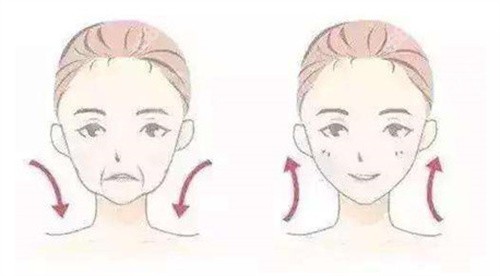 拉皮手术对比图