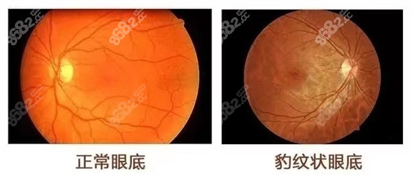 角膜地形图的介绍角膜地形图