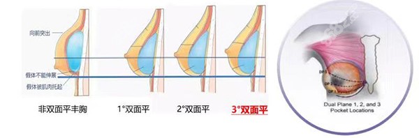 武汉艺星整形隆胸多少钱