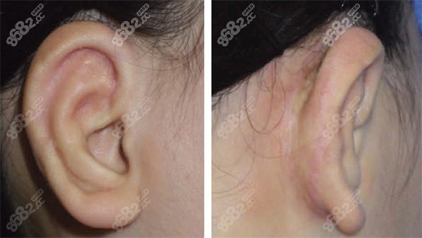 耳朵再造法手术技术详解