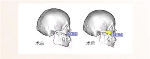 杭州下颌角截骨医生有哪些