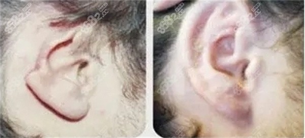 先天畸形或外伤导致的耳部缺损修复