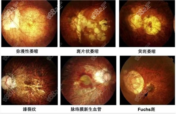 角膜地形图主要测量角膜