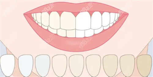 不同颜色牙齿对比图.jpg