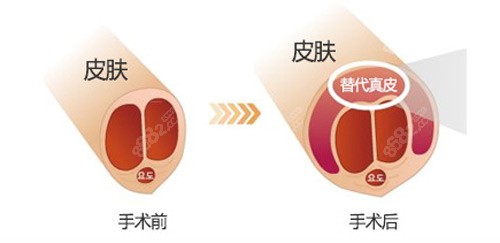 男性增粗手术前后差异