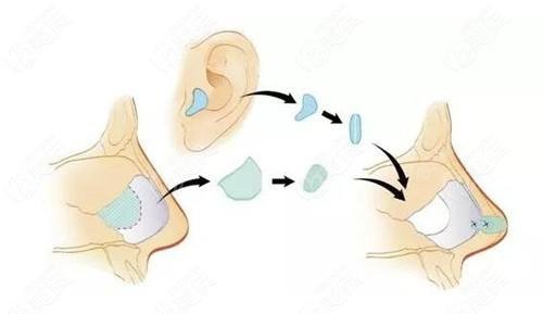 耳软骨隆鼻示意图