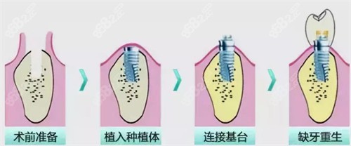 <!--<i data=20240705-sp></i>-->口腔医院种植牙多少钱？