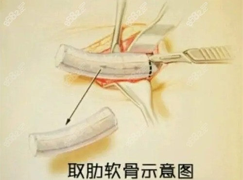 韩国GNG整形医院挛缩鼻修复口碑不错