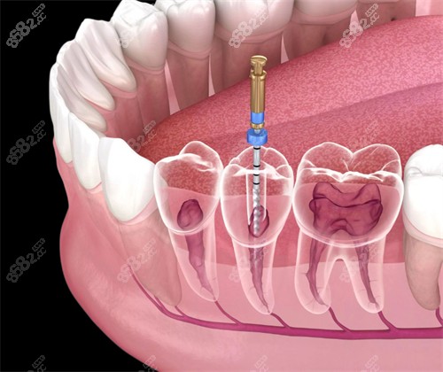 进行根管的牙齿